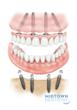Revolutionary Teeth in One Day Fixed Bridge Offered by Midtown...